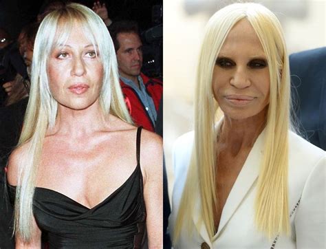 versace plastic surgery before and after|donatella versace before surgery.